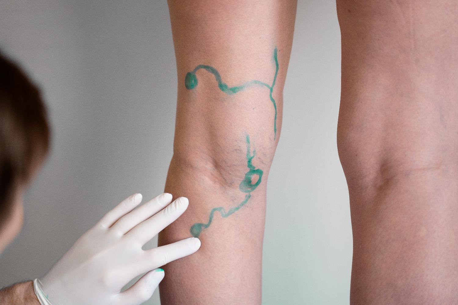 Gambe pesanti e vene in evidenza: quando l’Ecodoppler fa la differenza