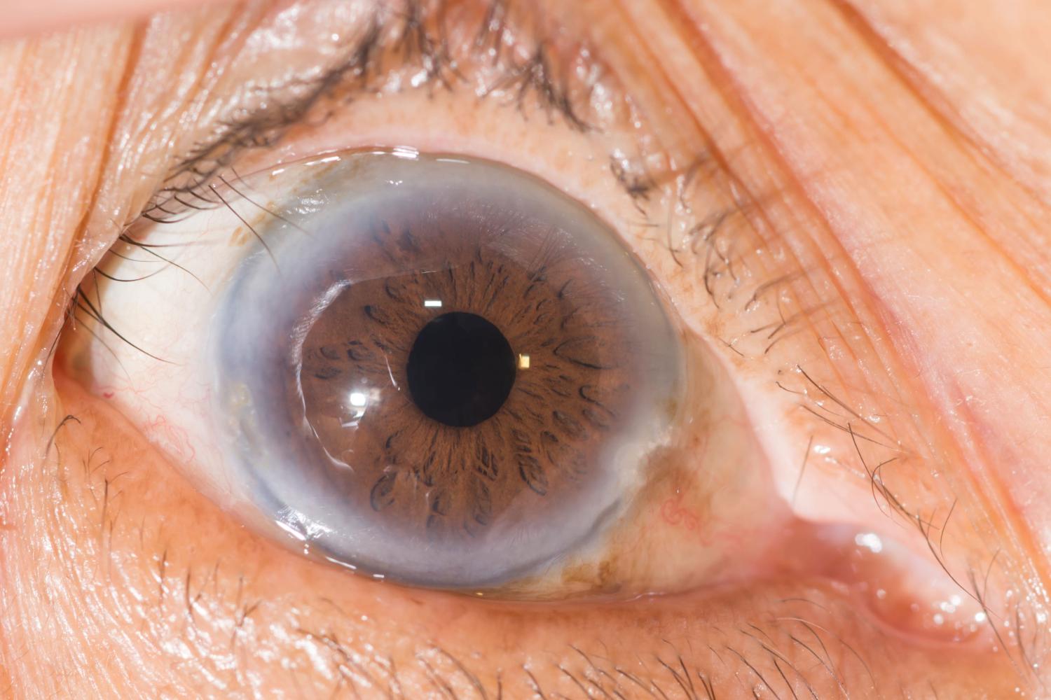 Oltre la cataratta: come le lenti intraoculari avanzate (IOL) eliminano la dipendenza dagli occhiali